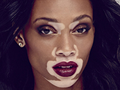 chantelle-winnie-vitiligo-skin-disease-model-photo-pic