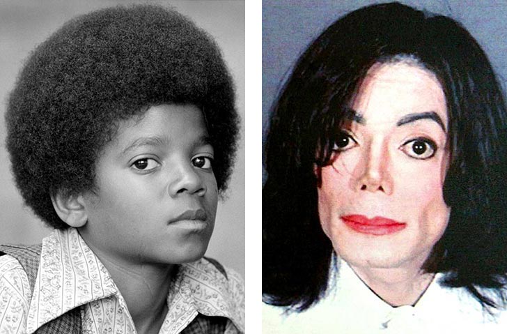 singer-celebrity-michael-jackson-skin-disease-condition-vitiligo-bleaching-photo-pictures