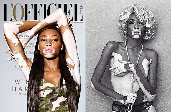 chantelle-winnie-harlow-black-model-with-vitiligo-pictures-photos